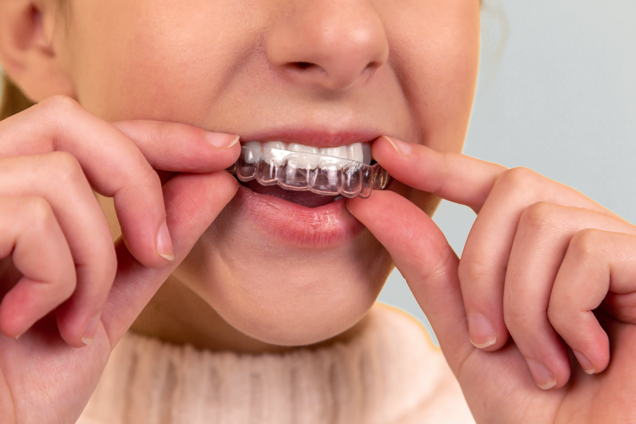 Ask Your North Houston and East Texas Dentist: Should I Get Metal or Clear  Braces?, Element Dental & Orthodontics