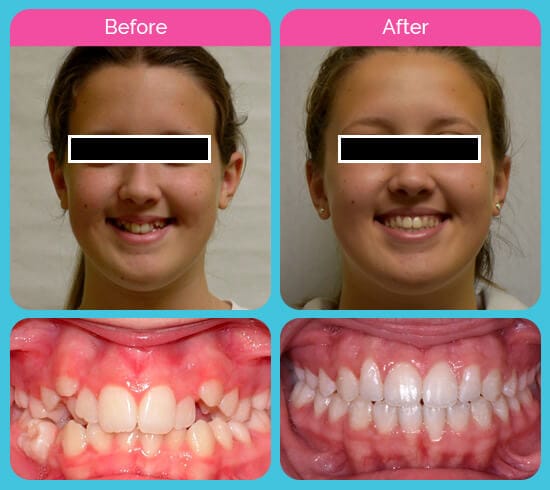 Before and after of a G Orthodontics client at Garcia Orthodontics Houston TX