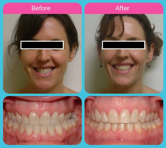 Before and after of a G Orthodontics client at Garcia Orthodontics Houston TX