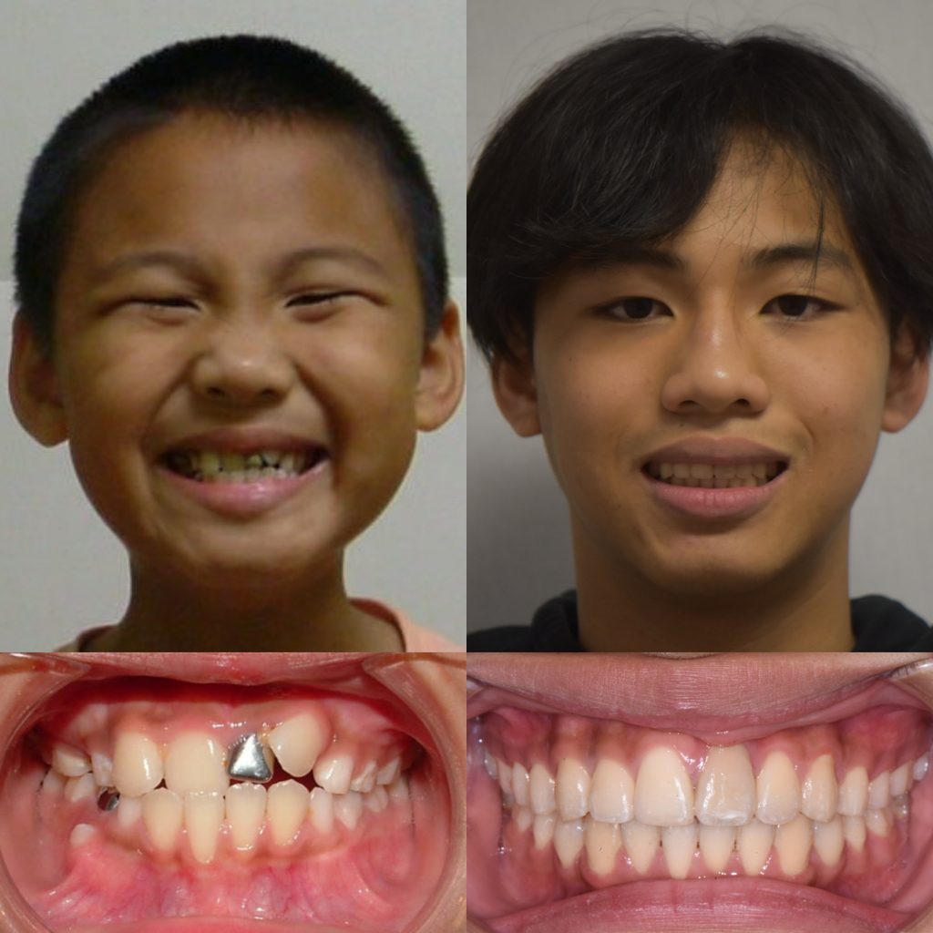 What is a crossbite? - g orthodontics - houston texas 1