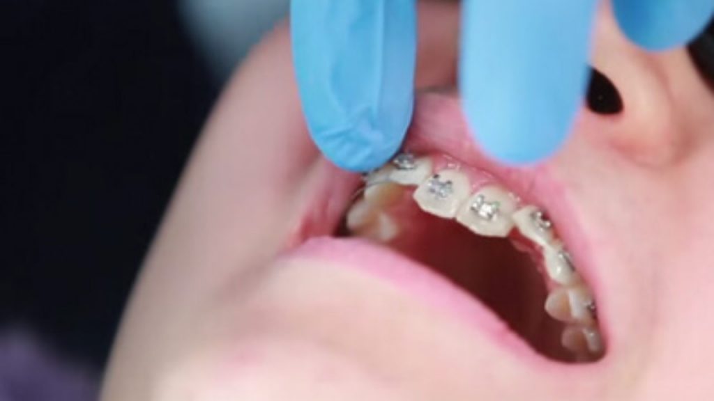gorthodontics-houston-texas-putting-braces-on-bonding-procedure