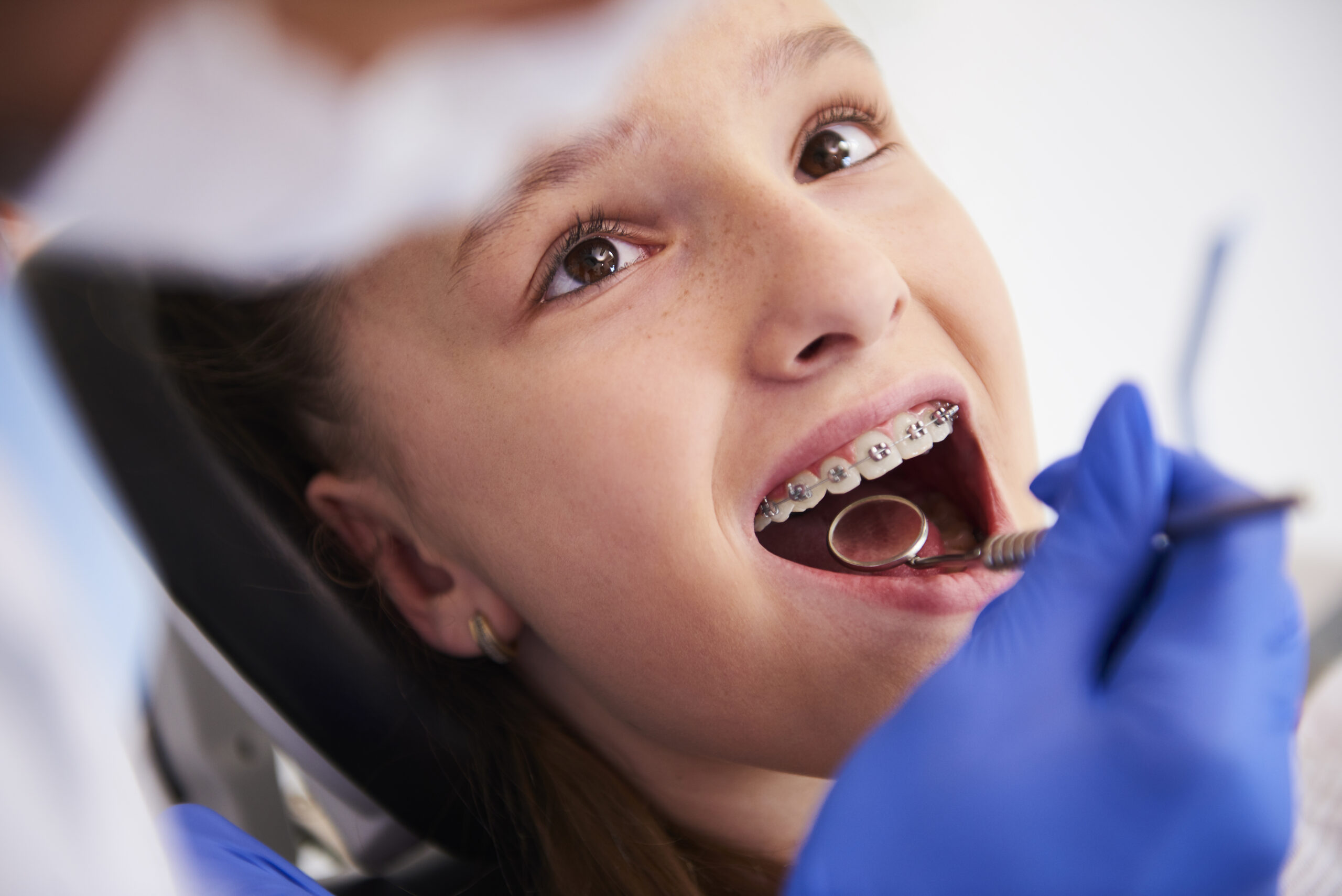 Orthodontic Care for Children: When is the Right Time to Start? 2