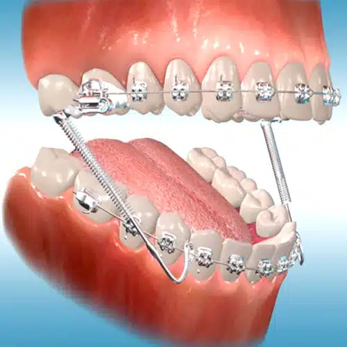 Gainesville_Dental_Arts_Dental_Appliance_Forsus
