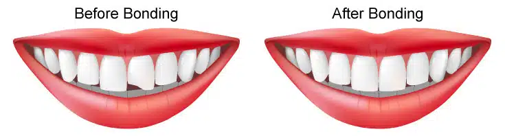 dental-bonding-2 (1)