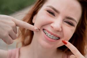 Young red-haired woman with braces on her teeth point to a smile outdoors in summer Houston InvisalignPage: Affordable & Effective Braces in Houston