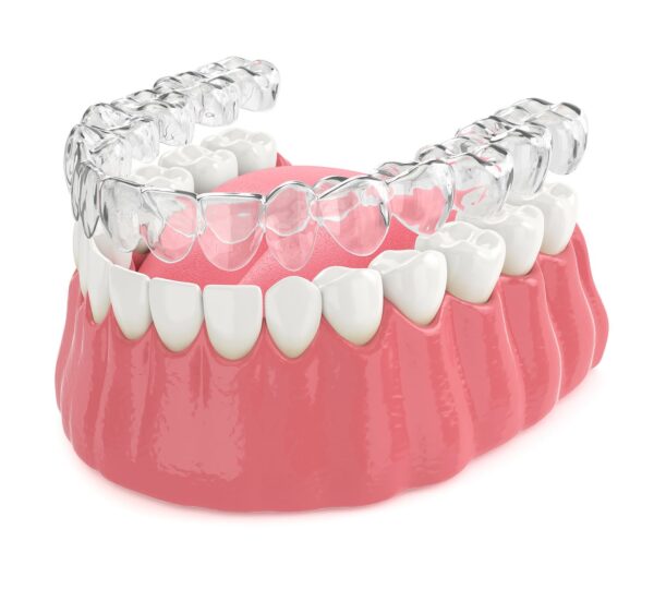 Dental model showing the clear aligner treatment process