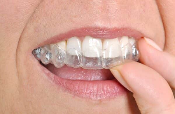 Closeup of a person placing invisible aligners on their teeth