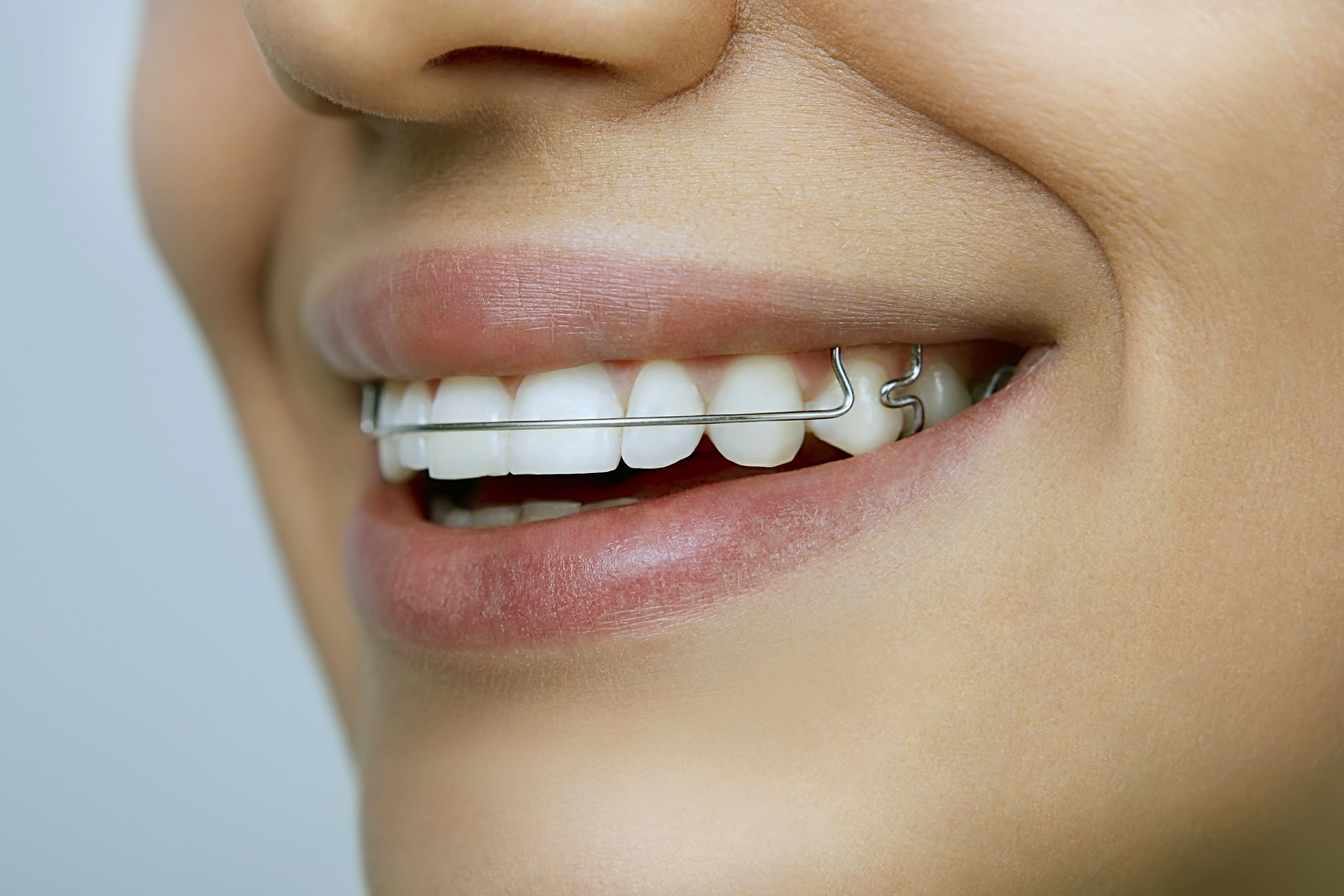 Smiling patient wearing a clear retainer demonstrating clear aligner treatment results