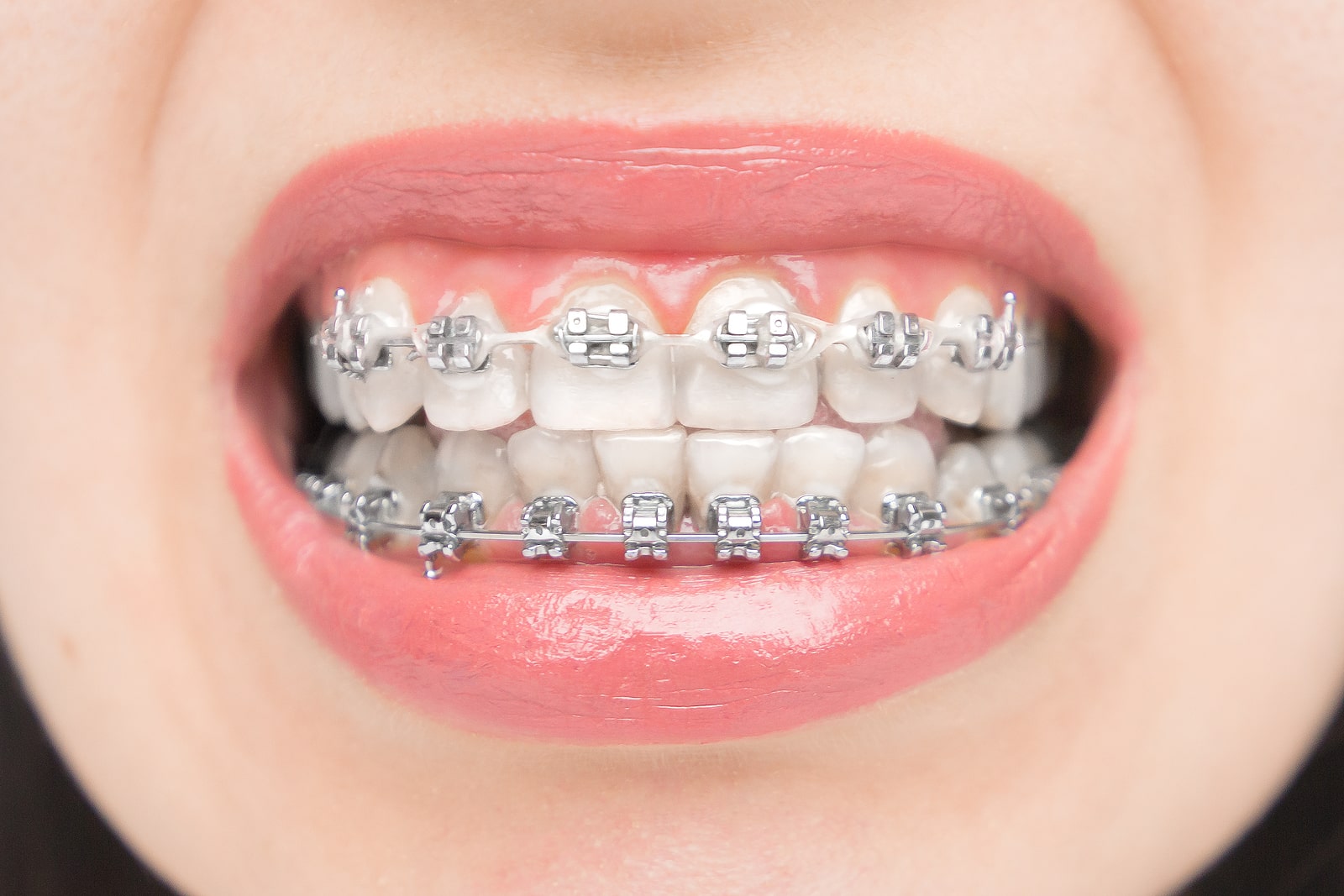 Close-up of teeth with metal braces showing different types of braces used in orthodontic care