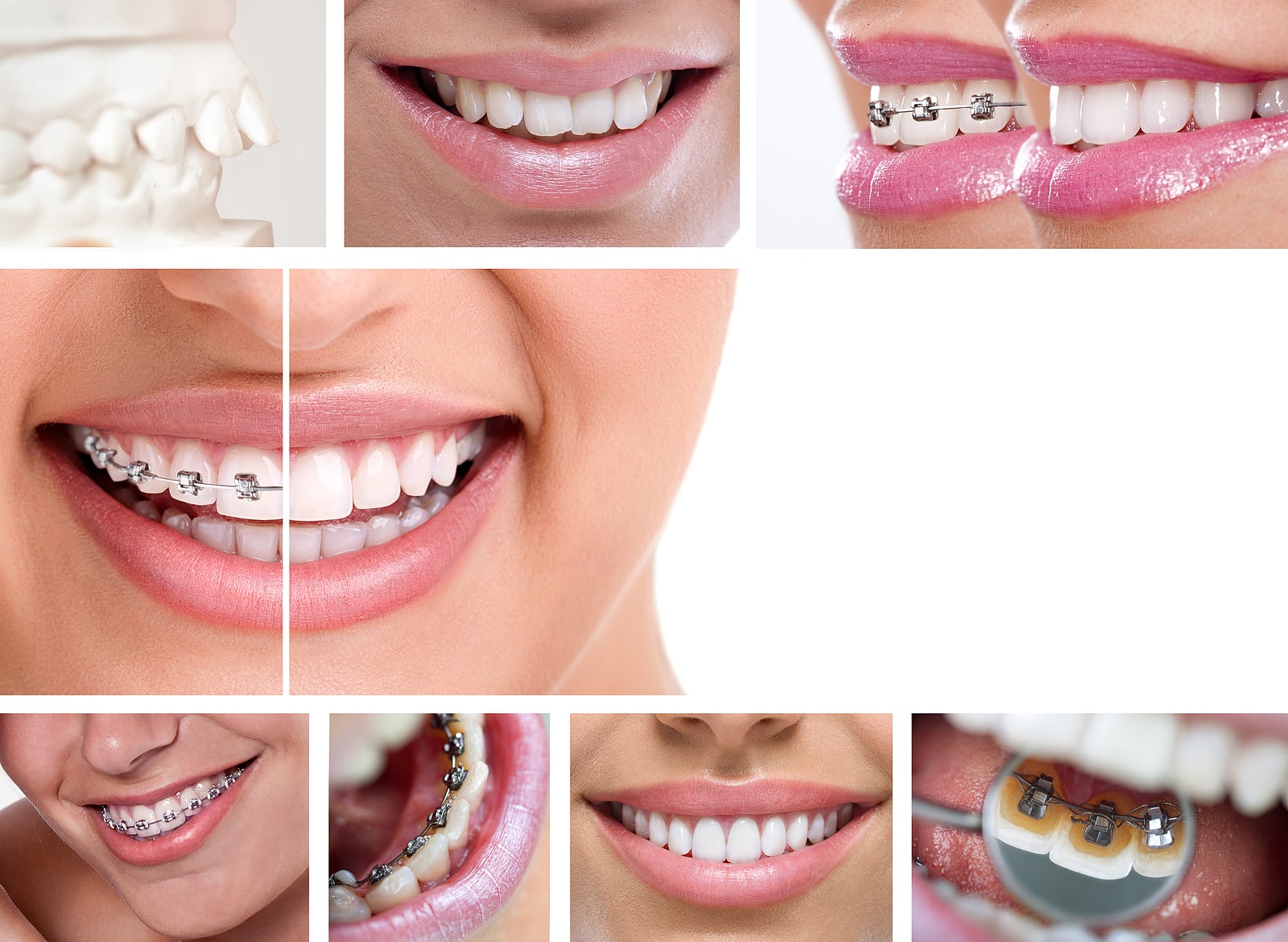 Close-up images of braces and orthodontic retainers supporting proper teeth alignment