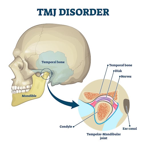 Medical diagram showing jaw joint anatomy used to explain TMJ disorder treatment and joint function