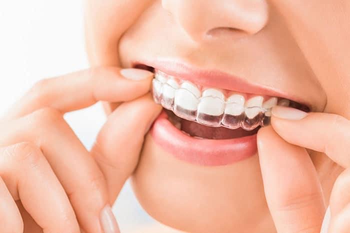 gorthodontics – Braces vs. Clear Aligners Invisalign 1